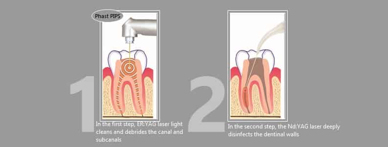 Laser Endodontic Treatment