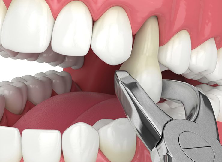 Tooth Extraction