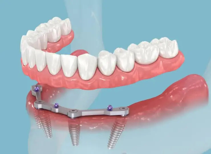 The Top Misconceptions About Dental Implants